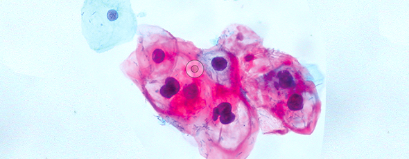 The HPV epidemic has led to a sharp increase in HPV-related head and neck cancer. Many patients survive, thanks to today’s treatments. But then they face new obstacles related to their condition. Clinicians at Pitt have realized that these survivors need coordinated care long-term.  Shown here: normal (blue) and HPV-infected cells (red). Image: Wikimedia Commons