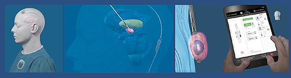 Deep brain stimulation is a treatment in which an electrode is implanted into the brain and a pulse generator into the chest; a thin wire beneath the skin connects the two. Patients can turn DBS off with a remote control; and during checkups, a doctor can adjust the pulse frequency and width, as well as the amplitude. The electrode lead has four sections, or contacts. In the latest models, the middle contacts are divided into thirds to help steer the current.     (DBS device image courtesy Abbott)