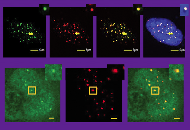 In this first row of images, Pitt’s Li Lan shows how the KillerRed dye (stained green) can be attached to sites of individual telomeres (marked with red dots). Blue is a nucleus. By breaking these components down in highly specific ways, Lan says, we can better understand how cancer cells build themselves back up. One way cancer cells repair damage is with an enzyme, a kinase called Nek7. In the second row of images, you can see the tiny dots of Nek7 glowing green, then the telomere-targeted damage caused by KillerRed (in red), and finally an overlay showing that Nek7 comes in to stabilize the telomere once it’s been damaged. No one knew this interaction existed until Lan brought it to light recently.