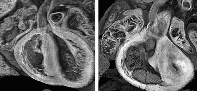 LEFT: Typically developing heart ventricles in a mouse. RIGHT: The heart of a mouse with a mutation resulting in an underdeveloped left ventricle, as seen in a rare condition in newborns.