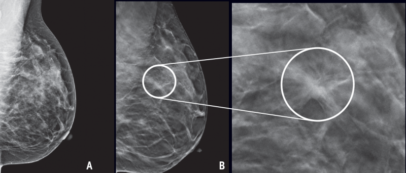 In dense breast tissue, tumors can be difficult to detect with standard mammography (A). The cancer here was not detectable on mammography but is more readily seen on 3D mammography (B, with close-up).