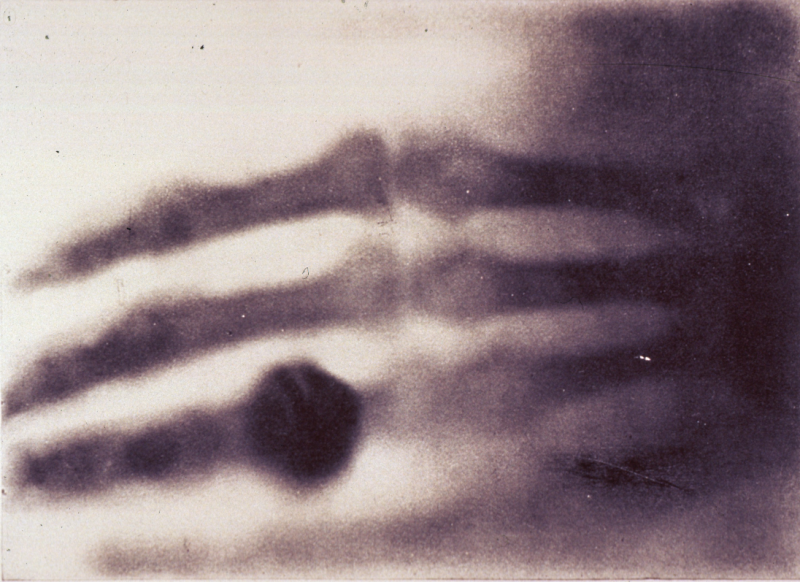 This is the first-ever X-ray image, taken by German physicist Wilhelm Röntgen in 1895. That bump? The ring of his wife, Bertha.