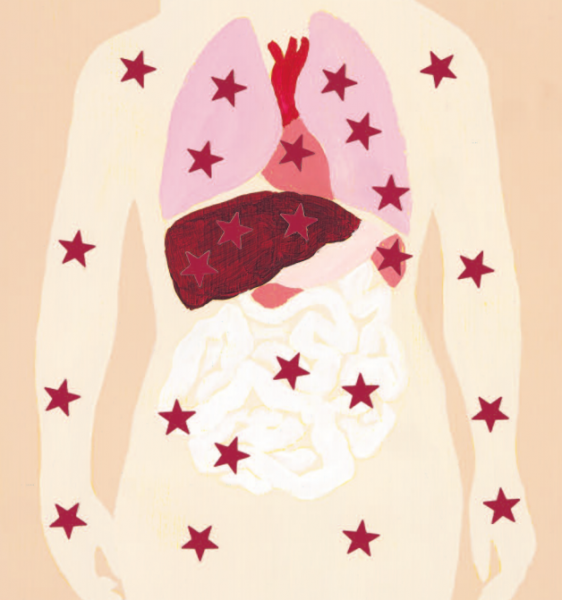 Systemic chimerism. The stars represent donor cells that migrated throughout the patient’s body from a transplanted organ.