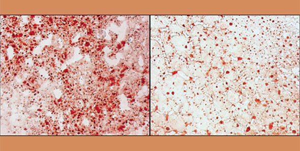 In a model of liver cancer, Prochownik compared tumors from control mice (left) with tumors from mice lacking Myc (right). Controls served up far more lipids (red), among other building blocks that are essential for cancer’s runaway growth.