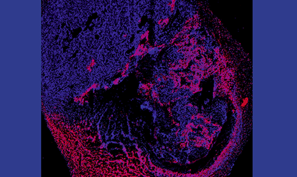 When cancer patients respond to immunotherapy, they do so beautifully. But only a minority of patients do. Greg Delgoffe’s team shows us how the microenvironment of the tumor can make or break a therapy. Above: Red and pink stains show where a melanoma tumor is beginning to lose oxygen. Tumor image courtesy Delgoffe Lab.