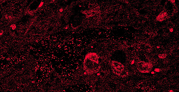 A red “molecular beacon” highlights LRRK2 activity in brain tissue of a person who died of Parkinson’s disease. Image: From “LRRK2 activation in idiopathic Parkinson’s disease,” Di Maio et al., Sci. Transl. Med. 10, eaar5429 (2018) 25 July 2018. Reprinted with permission from AAAS.