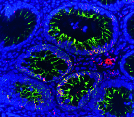A Pitt team has discovered how NSAIDs deter colon cancer. Here we see dying cells in a colon tumor from a patient treated with NSAIDs. The red areas indicate the activation of an enzyme by the cell-suicide trigger known as BID.