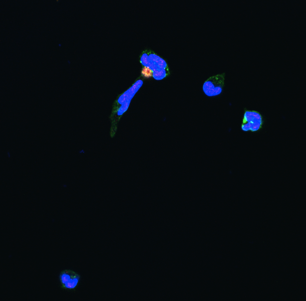 Neutrophil extracellular traps (NETs) spew from animmune cell circulating in the blood of a mouse followingmajor liver surgery. These weblike wisps arestudded with proteins (green) that spur cancer on.