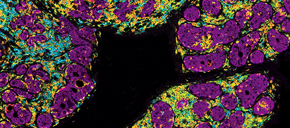 Invasive ductal carcinoma (pink and purple) of the breast shows infiltration by various immune cells: CD8+ T cells (orange),  B cells (cyan), and CD4+ T cells (green). Nuclei are blue.