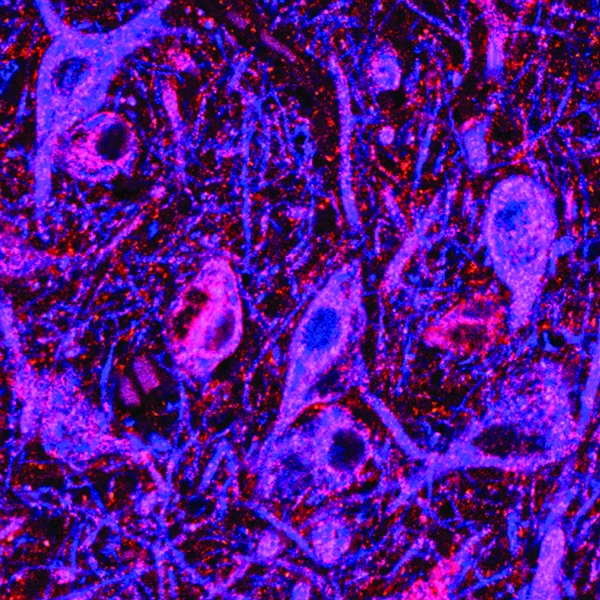 This image from J. Timothy Greenamyre and his team shows abnormal buildup of a protein, α-synuclein—pictured here in red—littering the landscape of the brain’s dopamine-producing neurons (stained blue). It is thought that too much α-synuclein impairs mitochondrial function. As the mitochondria falter, the neurons also falter and eventually die.
