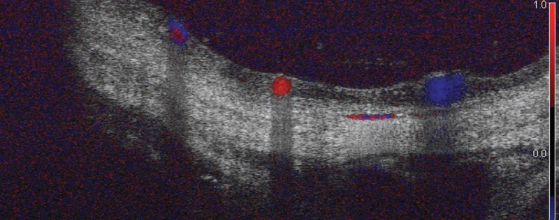 Doppler optical coherence tomograph of the transplanted eye. The red and blue shown here depict blood flow in the vessels in real time.
